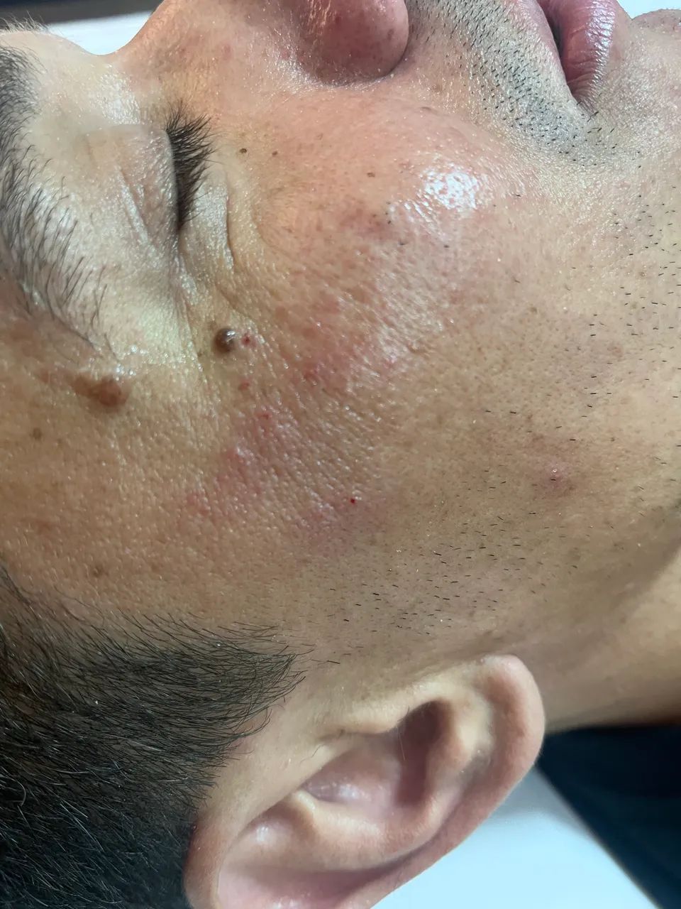 Limpeza de pele profissional  - Foto 4