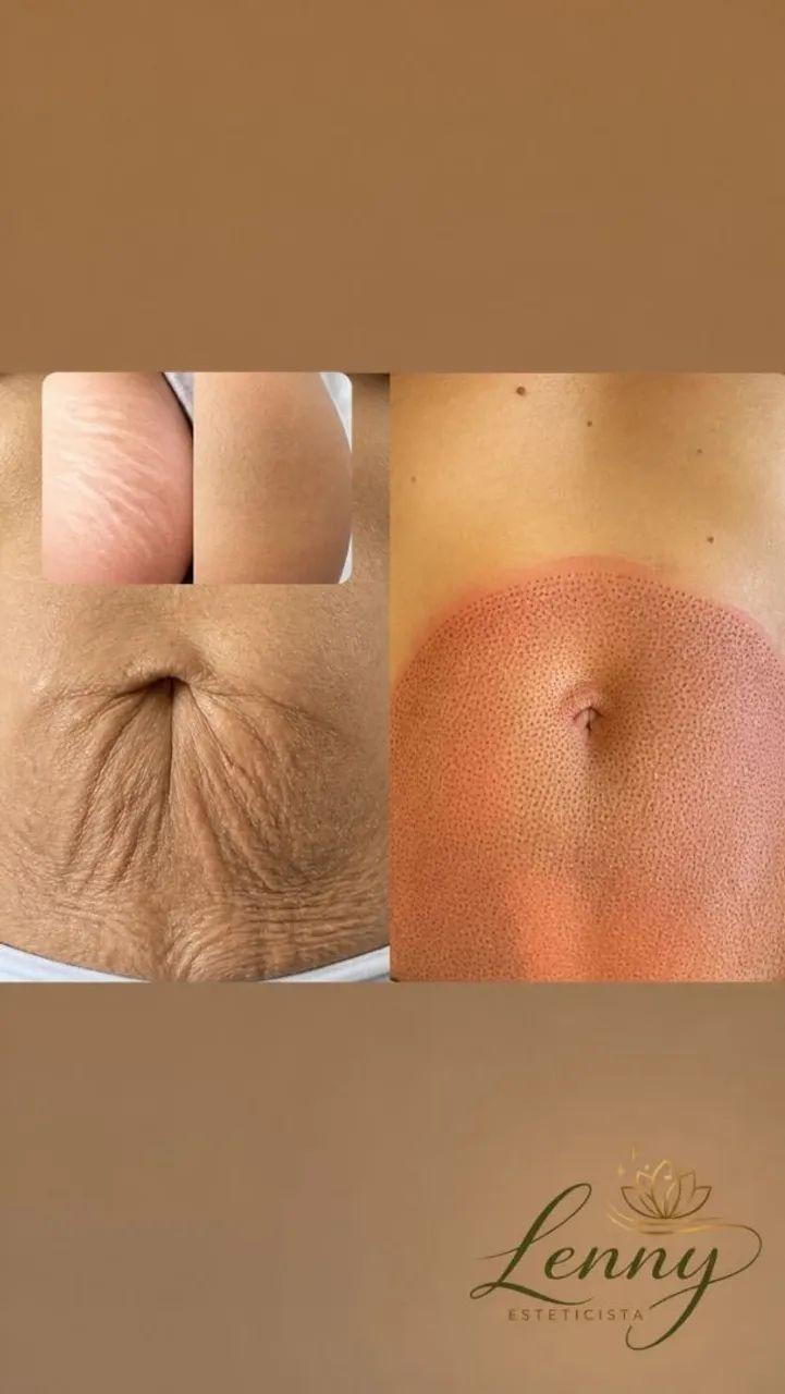 Tratamento para flacidez e estrias  - Foto 2