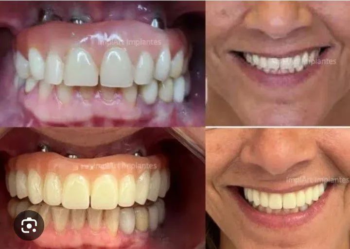 Prótese dentária - Foto 4