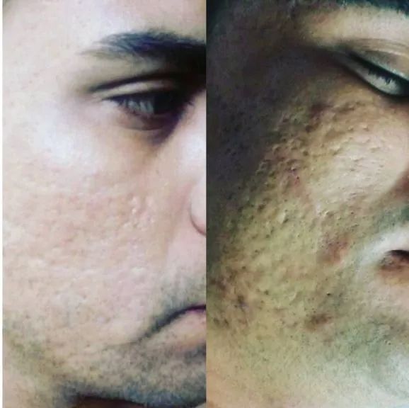 Limpeza de Pele 35+ - Foto 3