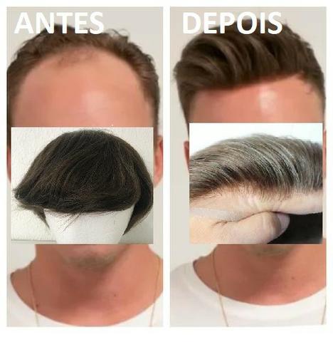 Preço promocional de prótese capilar com vouche de colocação em profissional top de linha