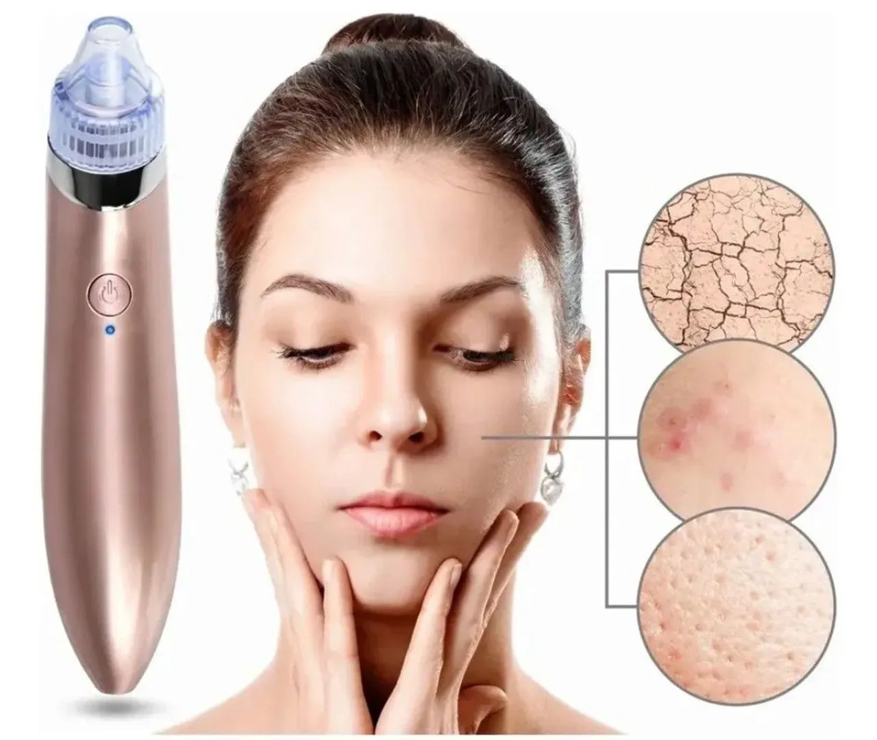 Removedor de acnes noco - Foto 3