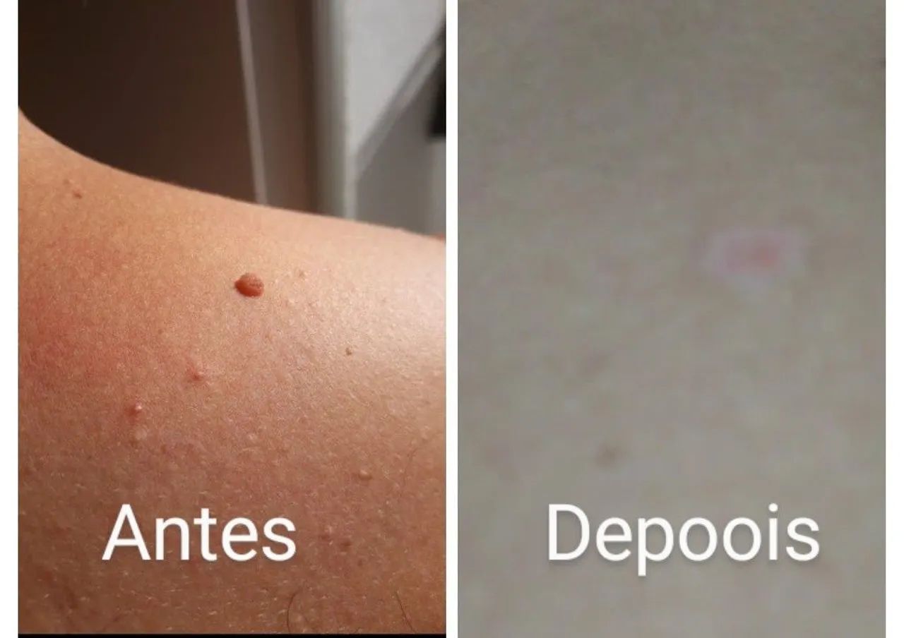 Promoção relâmpago. Quer retirar verrugas, sinais, aplicação de Jato.  - Foto 3