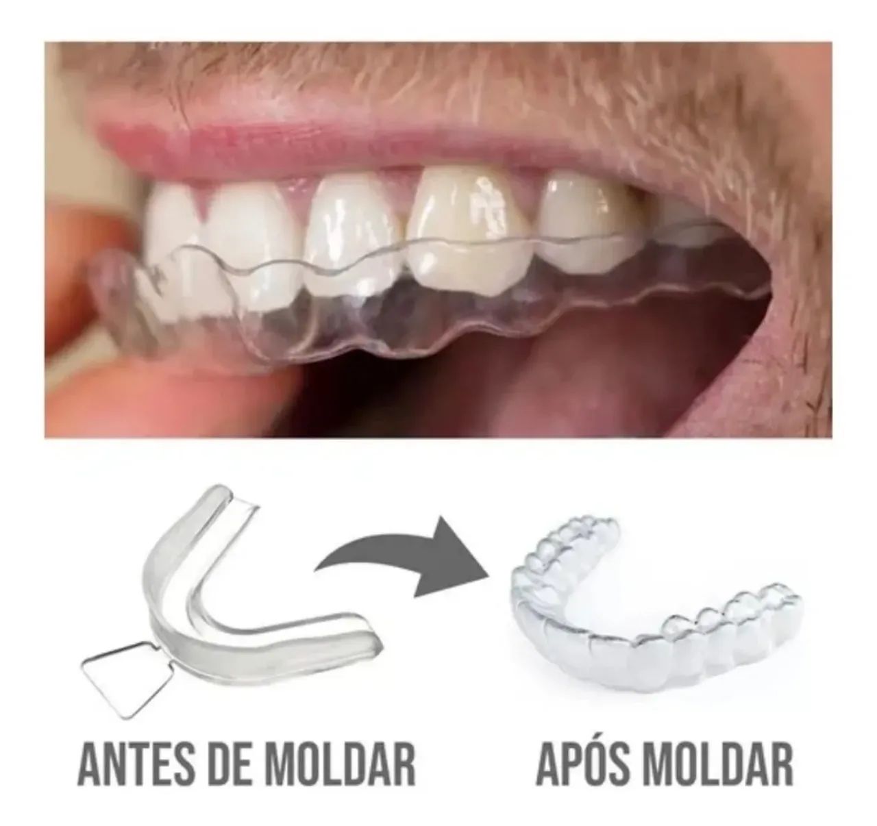 Placa protetor anti-bruxismo  - Foto 2