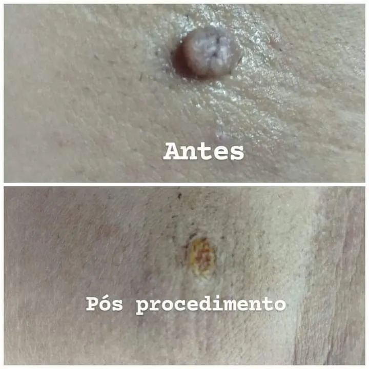  Remoção de Verruga  - Foto 2