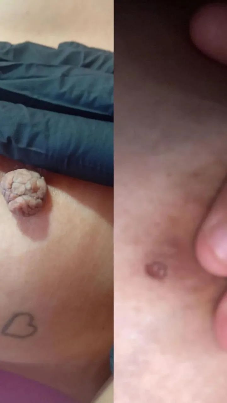  Remoção de Verruga  - Foto 3