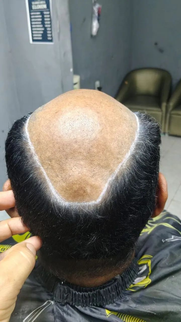 prótese capilar ' - Foto 2