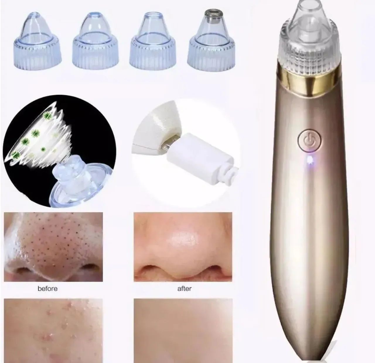 Removedor de acnes noco - Foto 4
