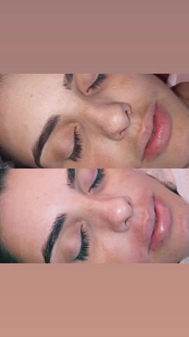 Limpeza de pele profunda + Dermaplaning - Foto 2