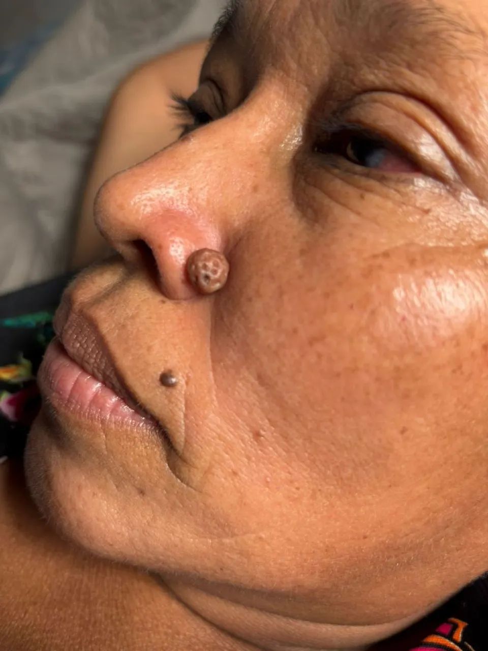 Remoção de verrugas e sinais. - Foto 2