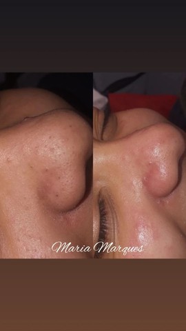 Limpeza de pele profunda + Dermaplaning - Foto 3