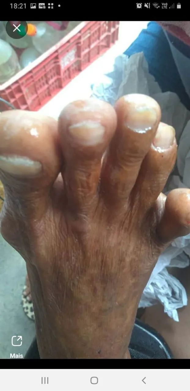 Tratamento de podologia  - Foto 2