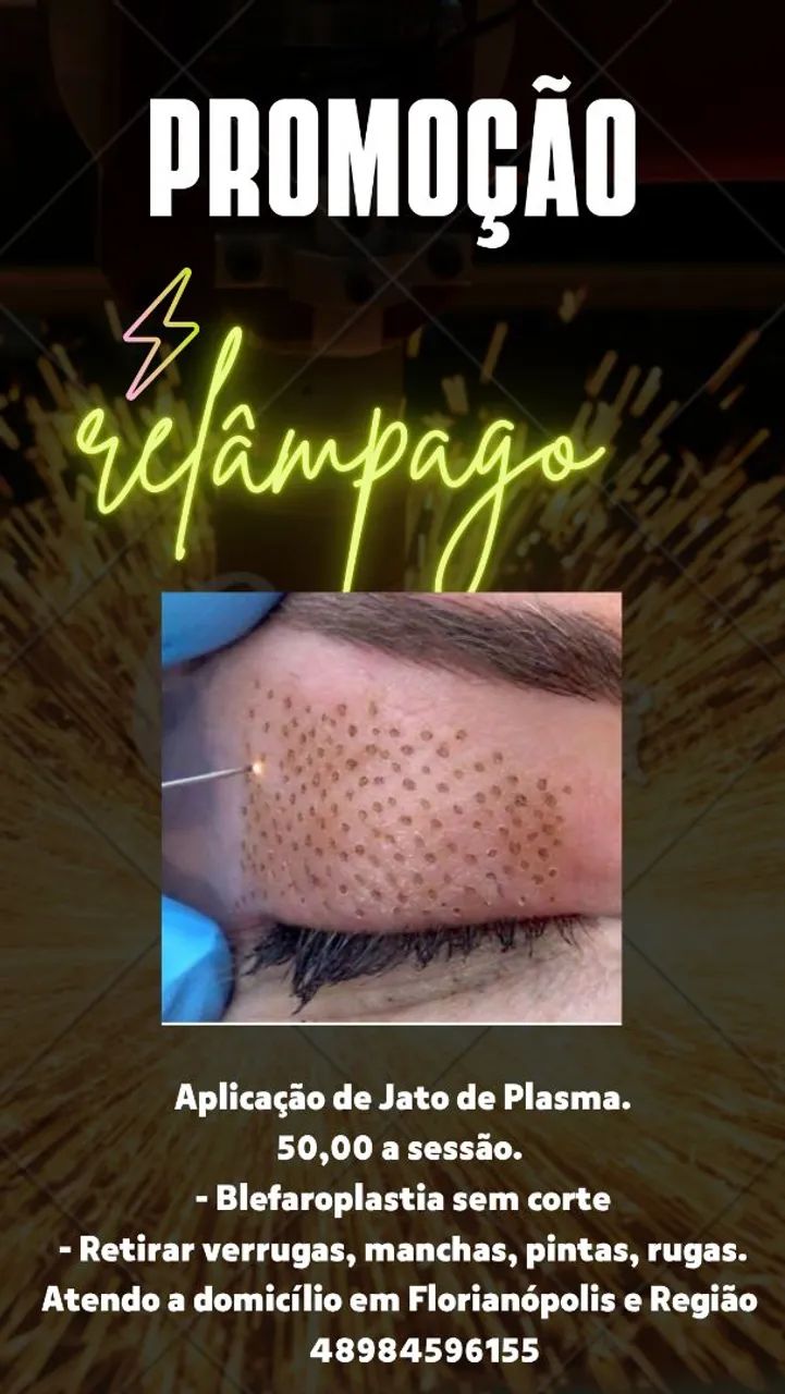 Promoção relâmpago. Quer retirar verrugas, sinais, aplicação de Jato.  - Foto 5