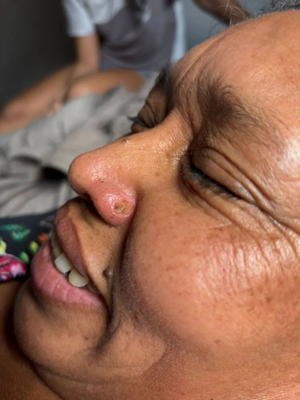 Remoção de verrugas e sinais. - Foto 3