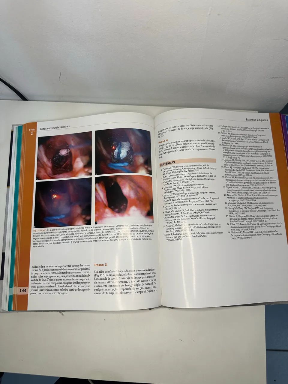 Endoscopia de Laringe? Atlas