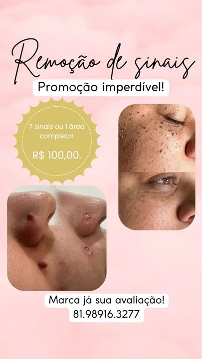 Remoção de Sinais - Promoção Imperdível!