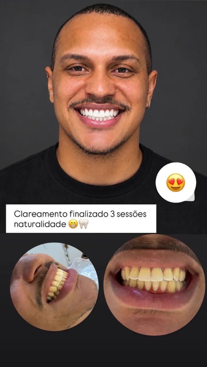 Clareamento consultório 