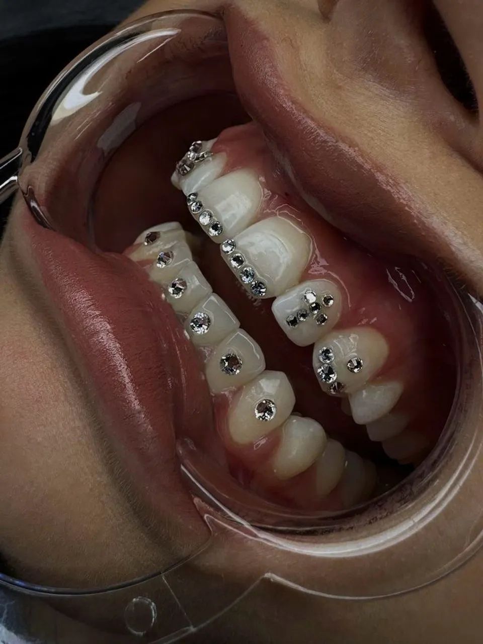 Piercing dental 50,00 - Foto 3