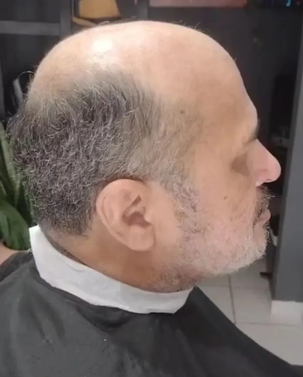 Prótese capilar