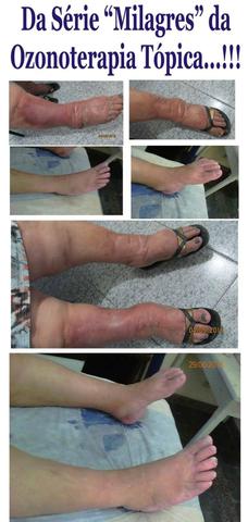 Tratamento de varizes com ozonioterapia