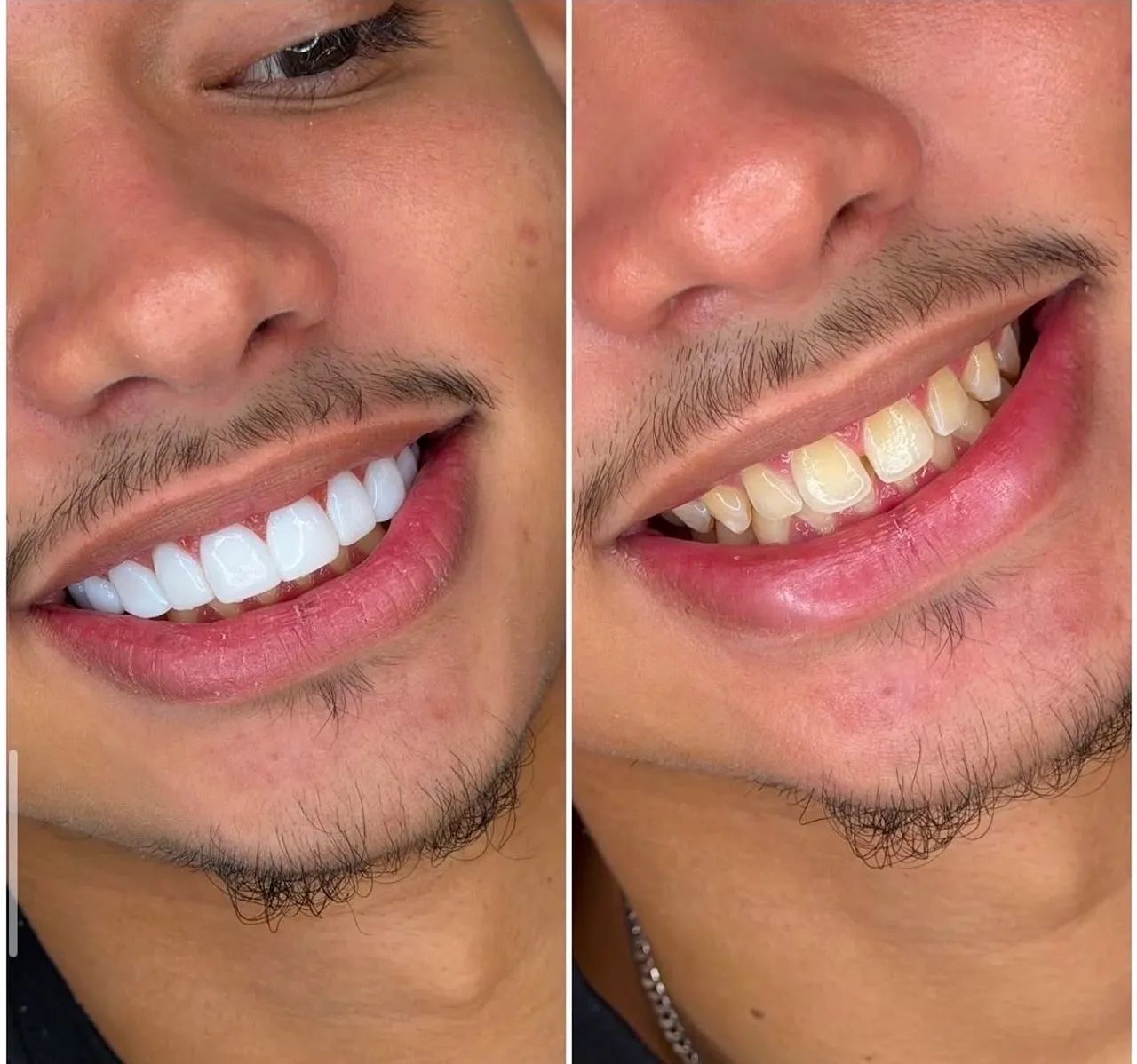 Facetas em resinas 