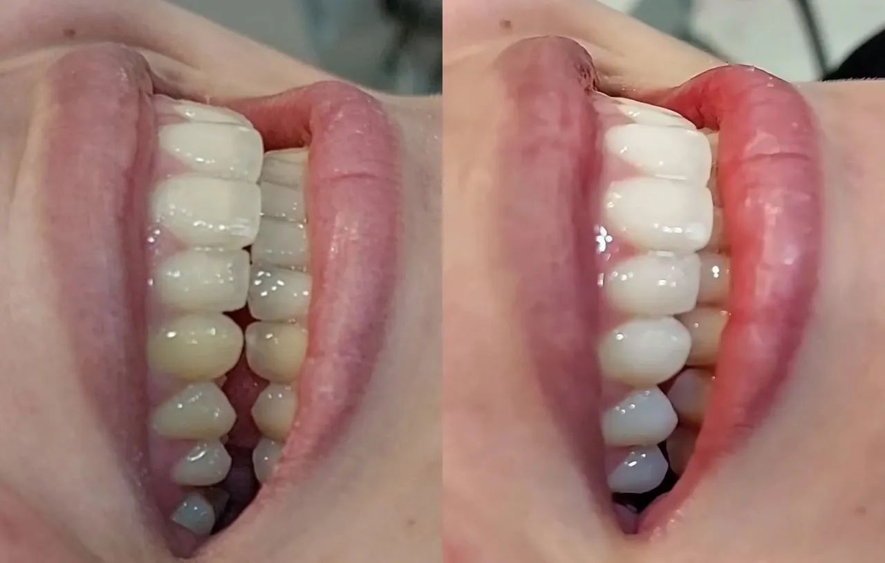 Clareamento dental laser  - Foto 2