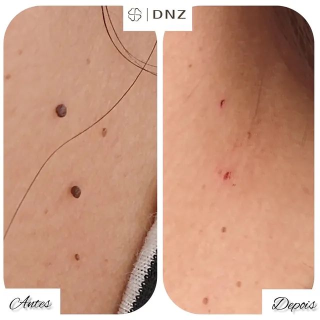 Remoção de verruga ou sinal pequeno 