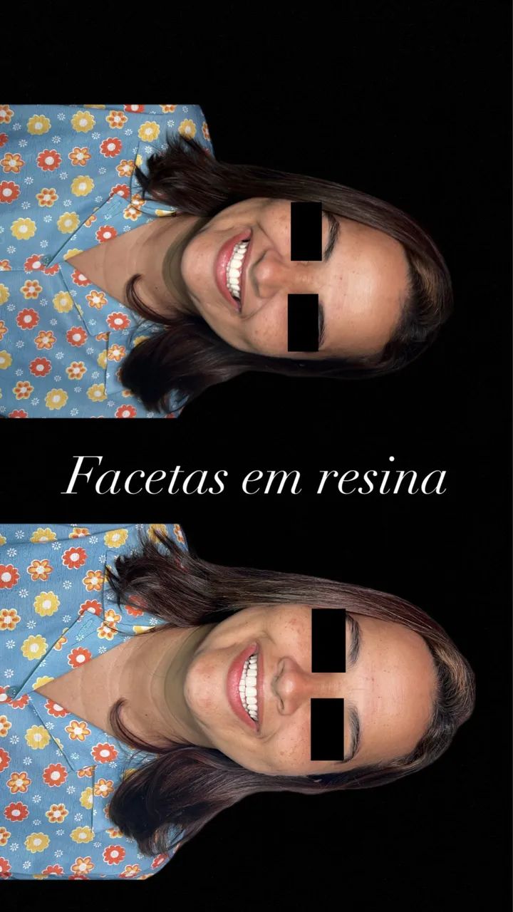 Facetas em resina 600 reais 