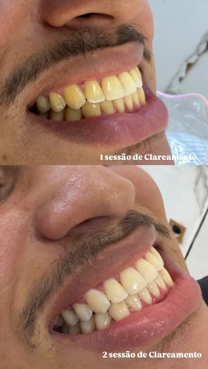 Clareamento consultório  - Foto 3