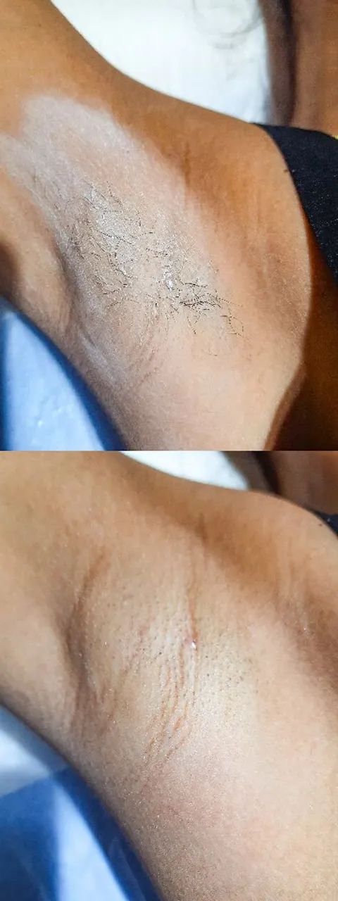 Depilação com cera - Foto 4