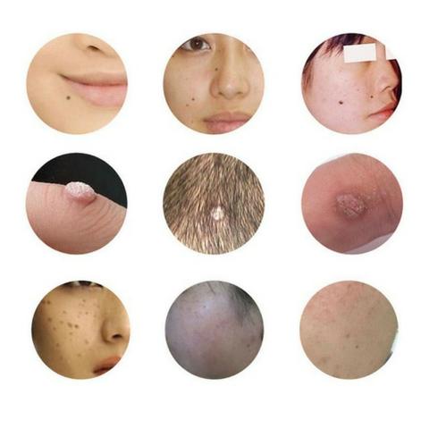 Jato de Plasma Caneta Despgmentadora Elimina Manchas Verrugas 3 níveis Analogica - Foto 4