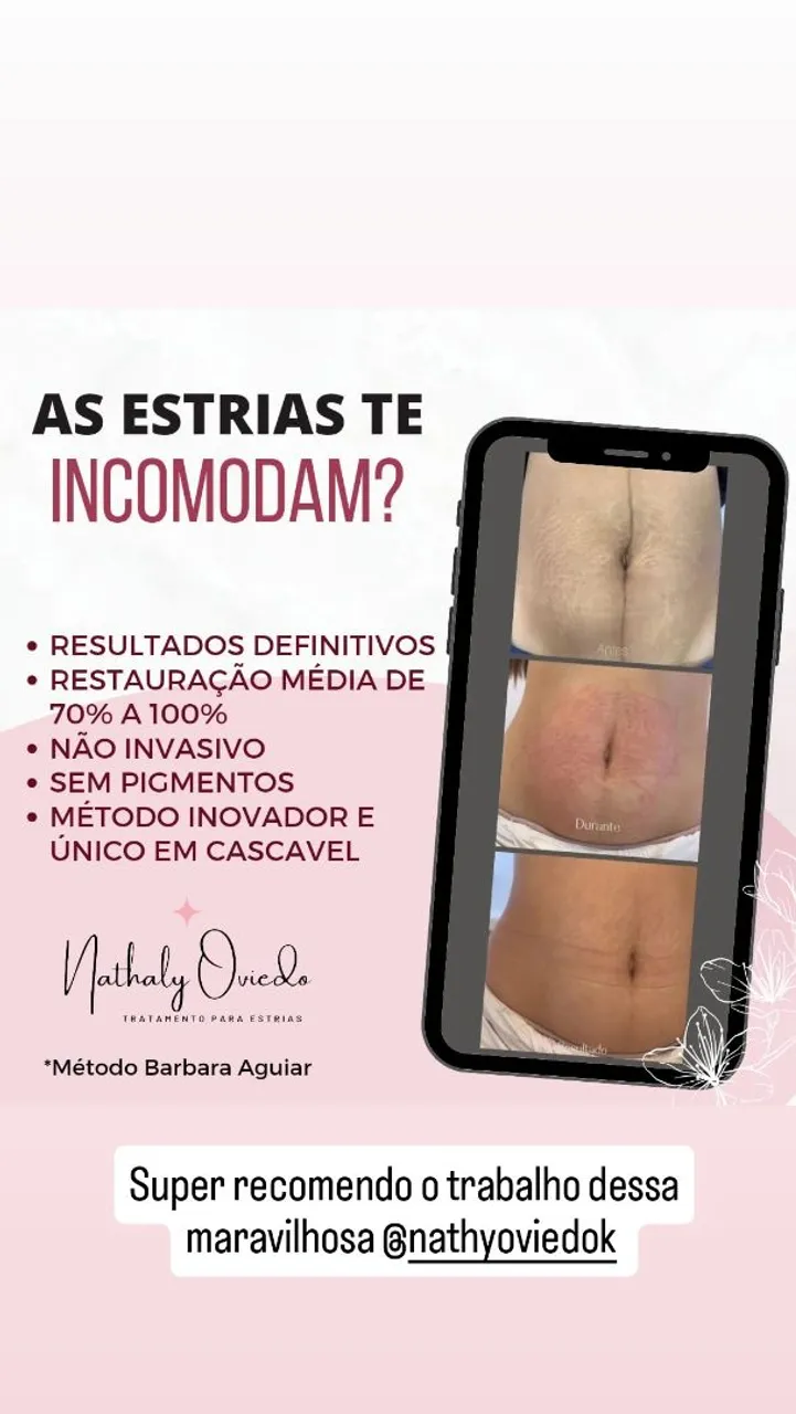 Tratamento de estrias com resultados definitivos