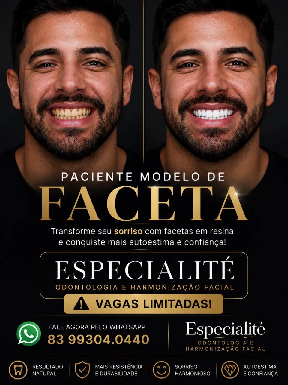PACIENTE MODELO PARA FACETAS EM RESINA EM JOÃO PESSOA 