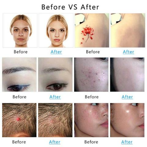 Caneta Laser Picossegundo Neatcell Azul Elimina Rugas Verrugas e Tatuagnes Tatoo - Foto 4