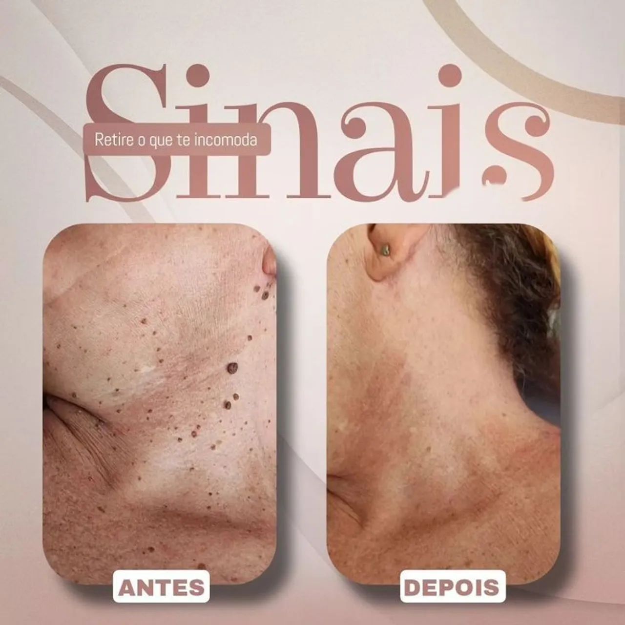 Cauterização de pintas e verrugas 