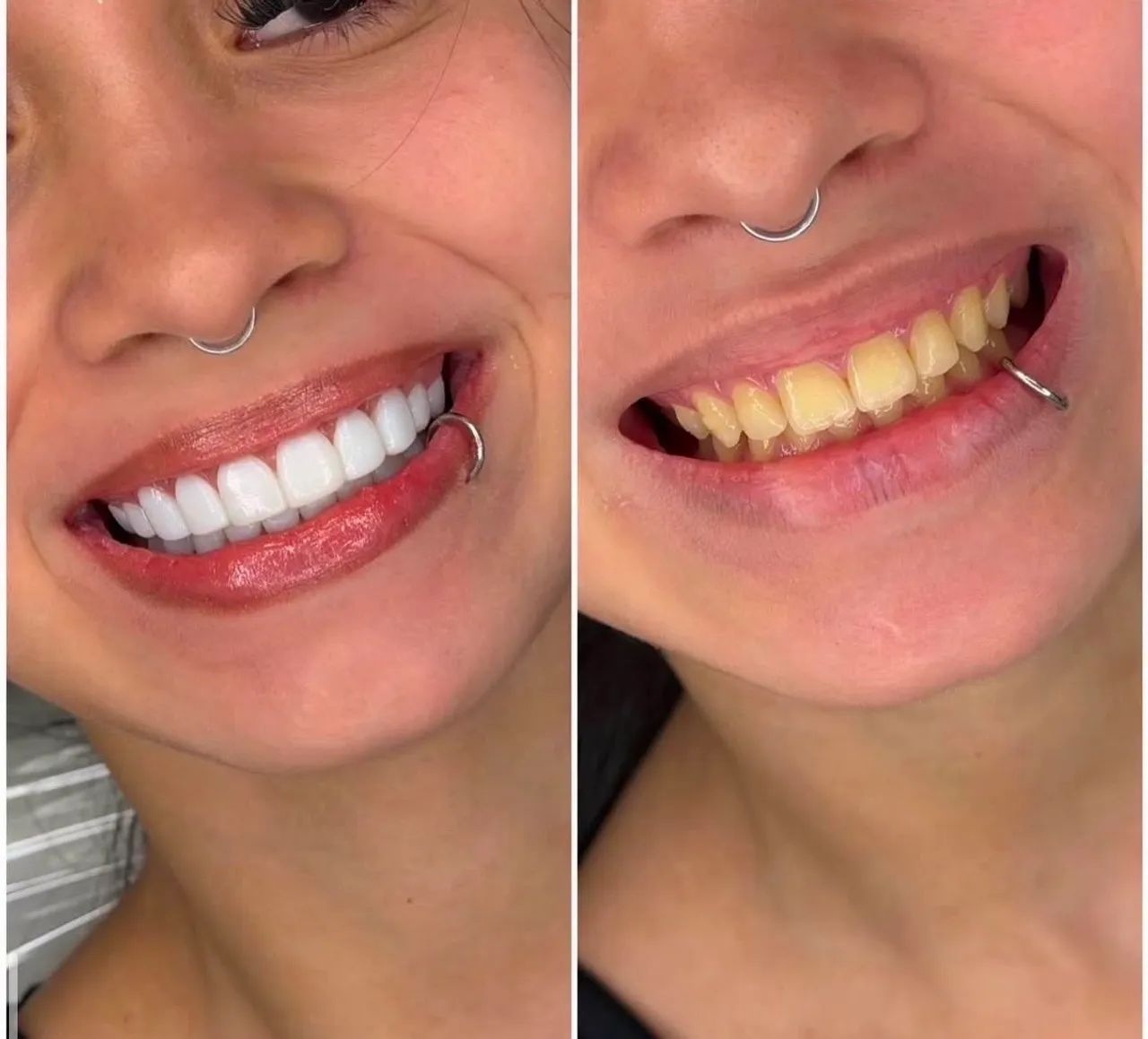 Facetas em resinas  - Foto 2