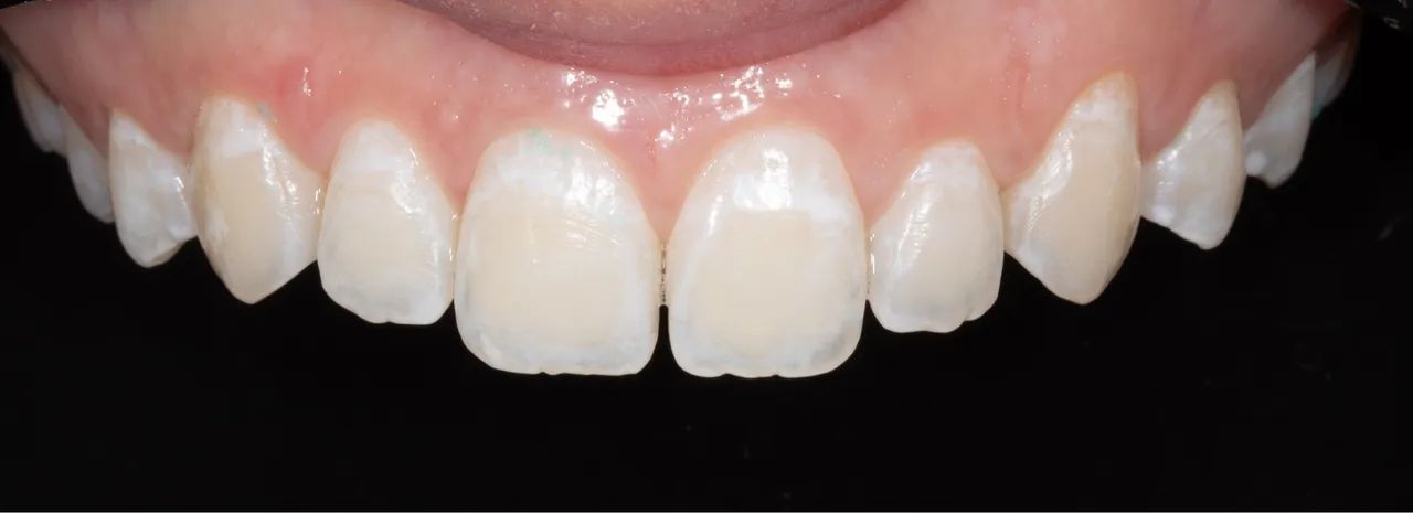 Lente Canon Macro 100mm - Foto 4