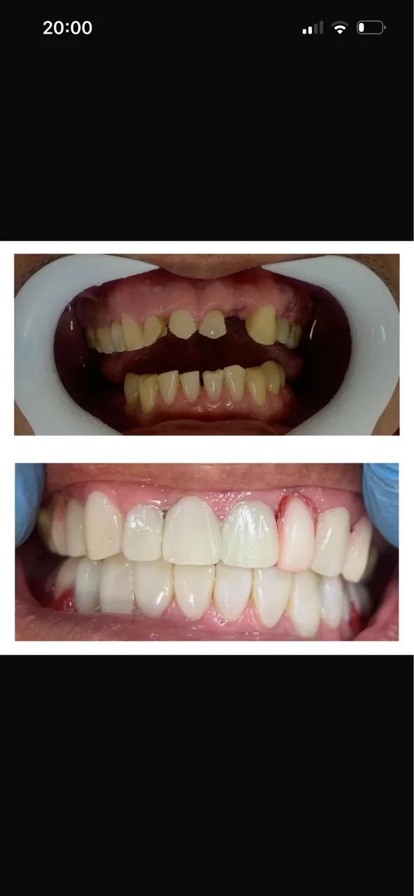 Facetas em resina 600 reais  - Foto 2