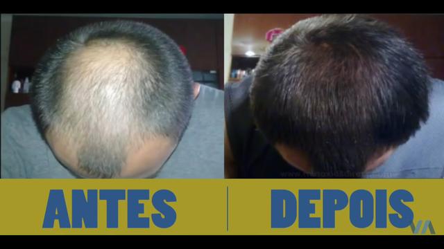 Minoxidil - Foto 4