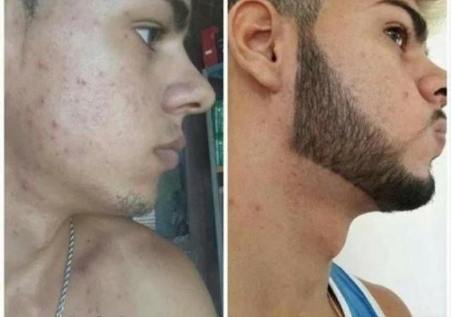 Minoxidil - Foto 3