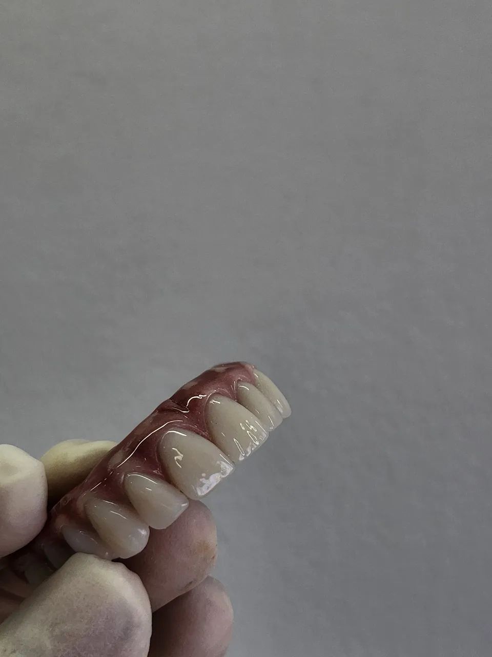 Confecção de dentaduras e proteses com grampo