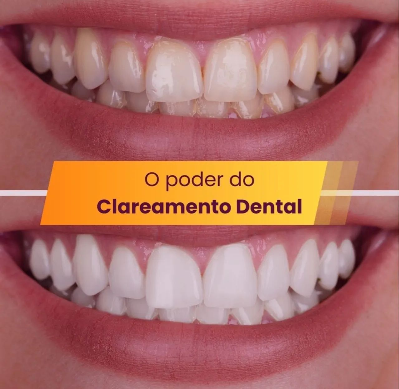 Clareamento dental laser 