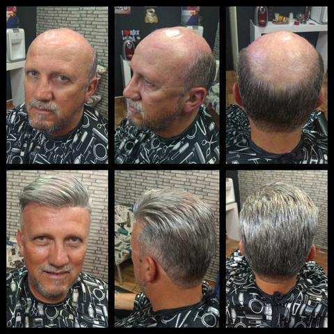 Prótese de cabelo