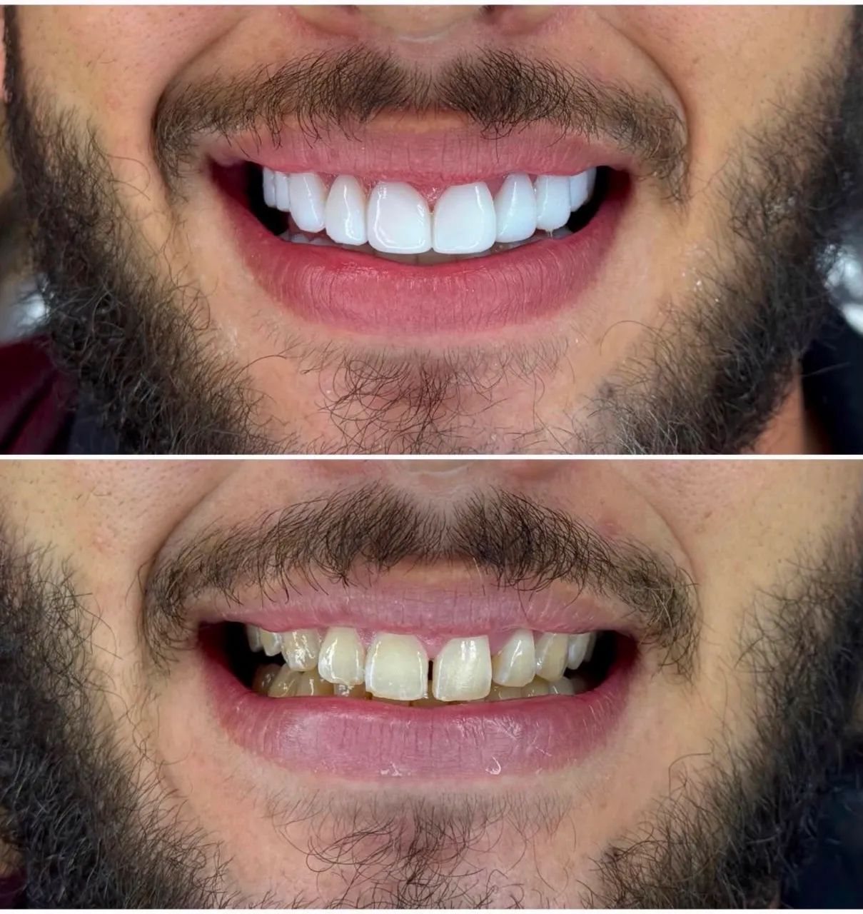 Facetas em resinas  - Foto 3