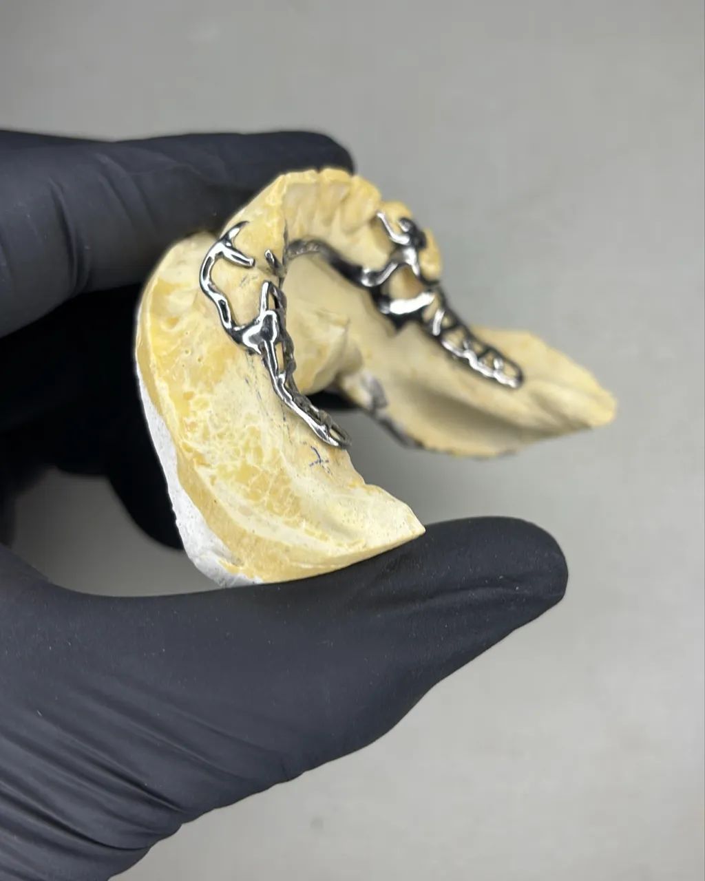 PPR. Prótese Parcial Removível Metálica