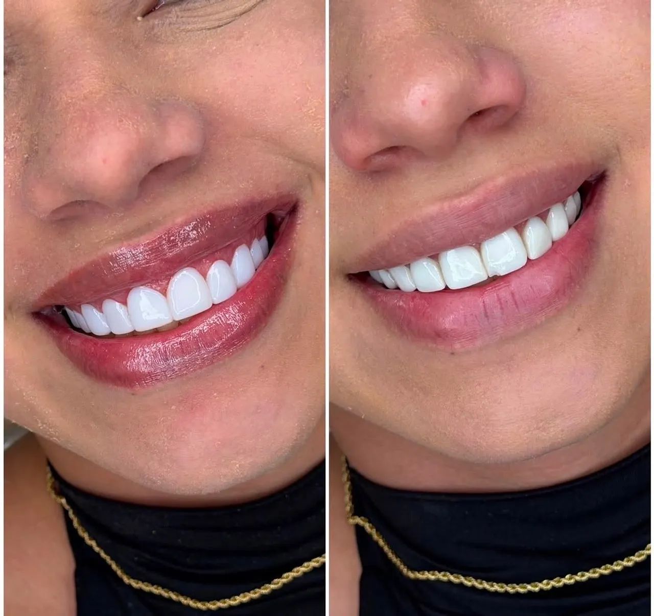 Facetas em resinas  - Foto 4