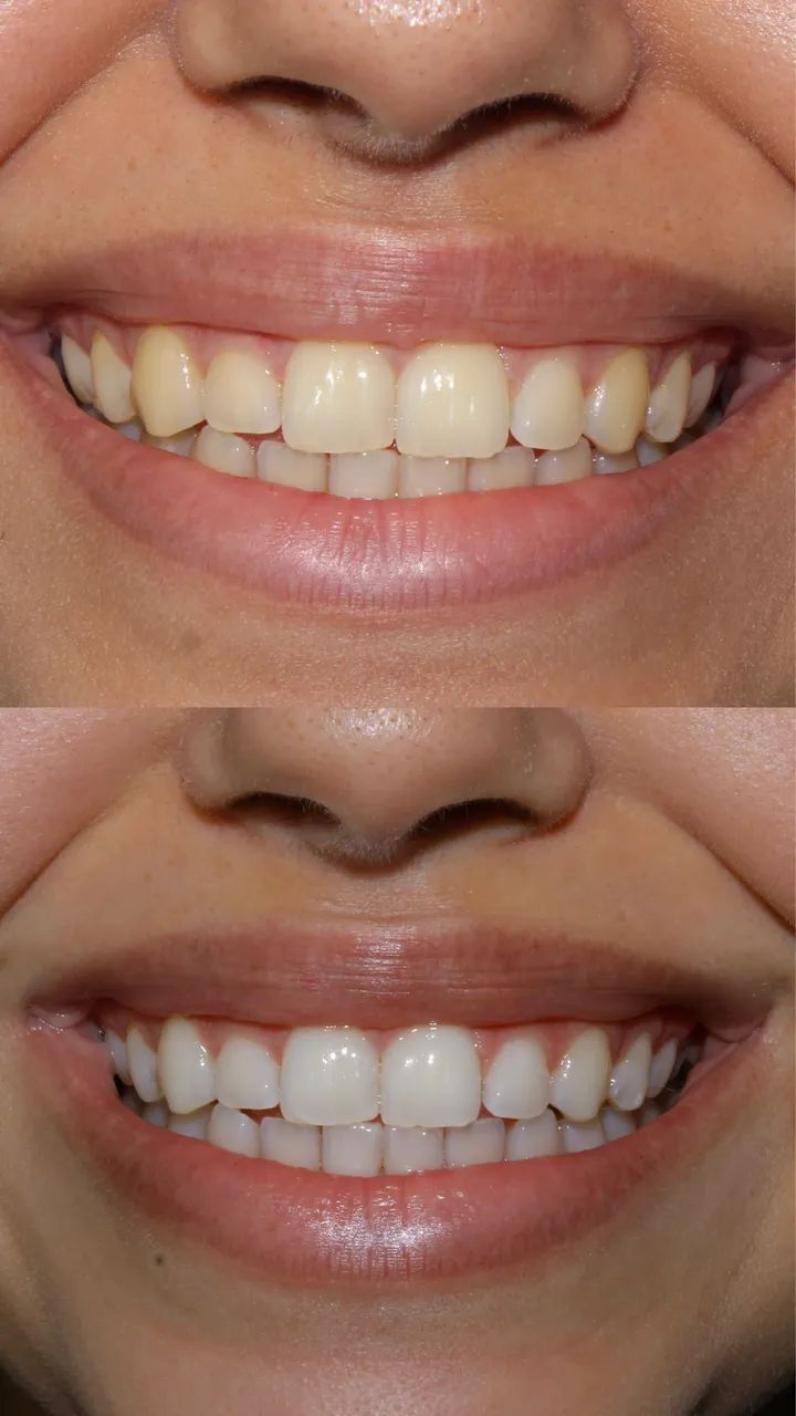 Clareamento dental em consultório  - Foto 2