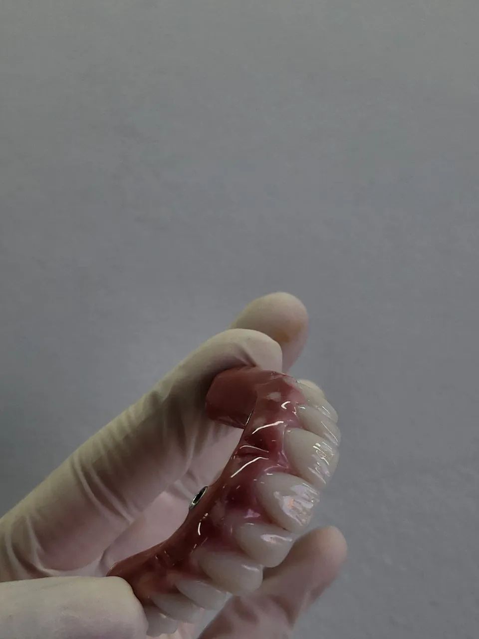 Confecção de dentaduras e proteses com grampo - Foto 2
