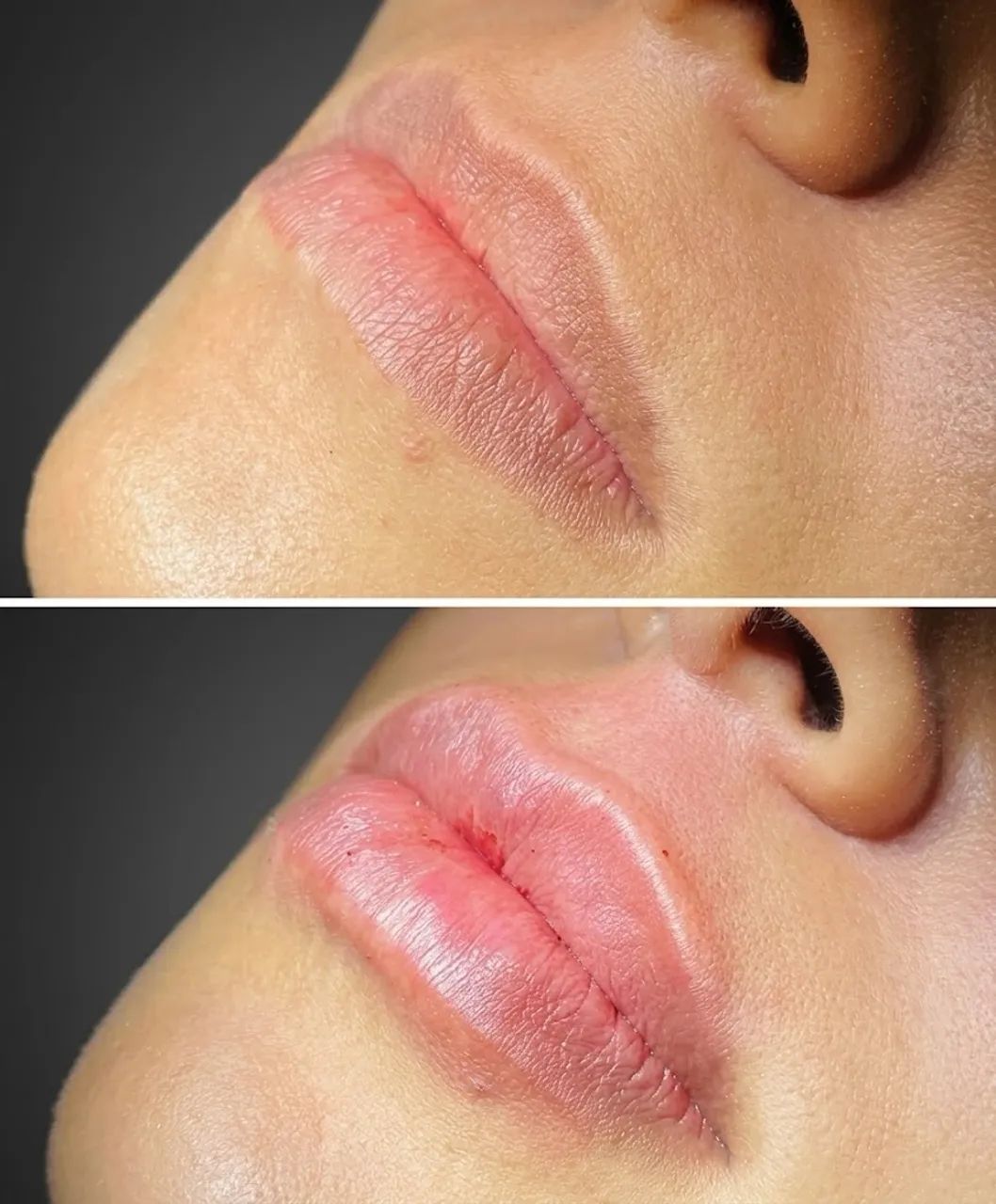 Preenchimento Labial R$450 - Foto 2