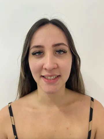 Faceta em resina !!  - Foto 4